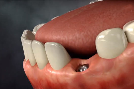 Implant design research clinical outcome of i fix implant kamal medtech