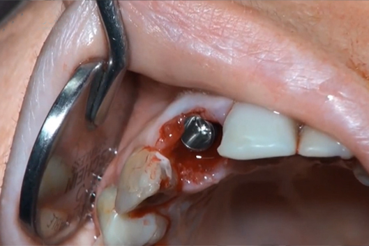 Medbone immediate loading implant using adbone tcp kamal medtech