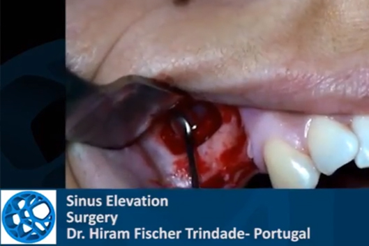 Sinus elevation dr hiram fischer using medbone kamal medtech